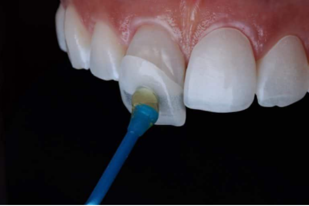 تبييض الاسنان باستخدام الفينير